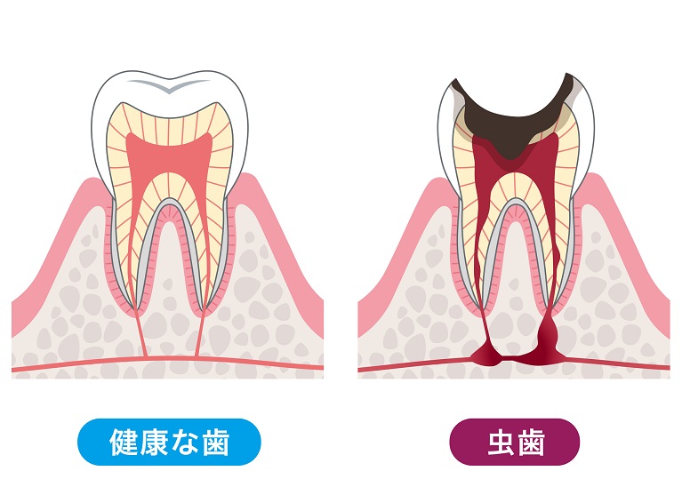 虫歯