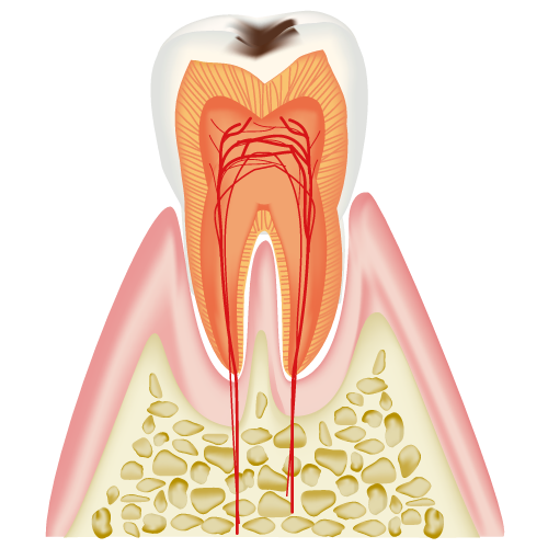 C1（エナメル質の虫歯）