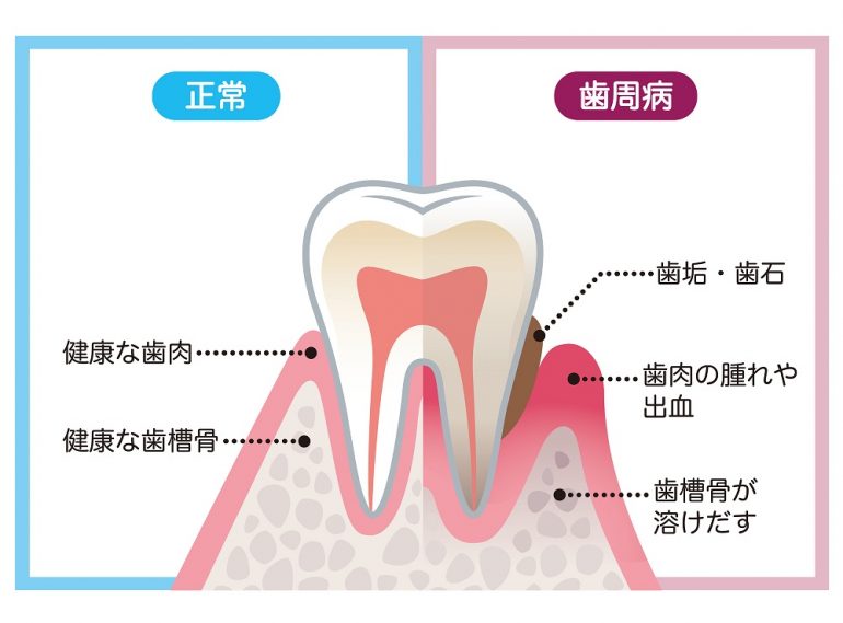 歯周病