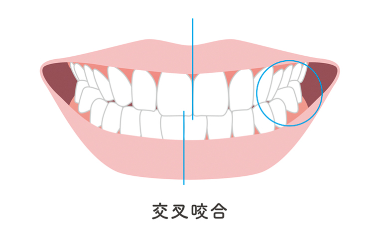 交叉咬合